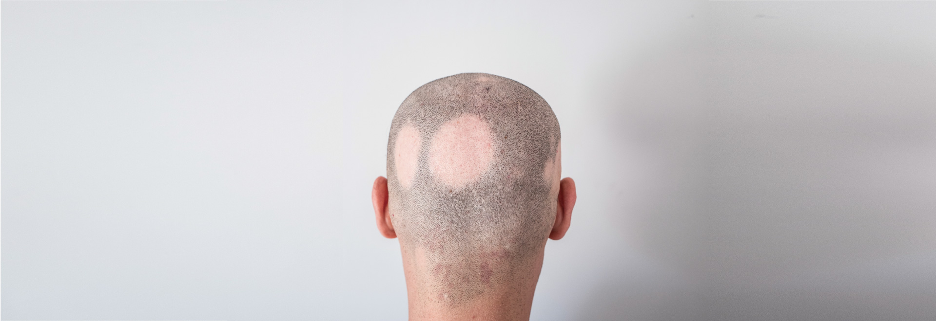 alopecia-causes-symptoms-treatment-prevention