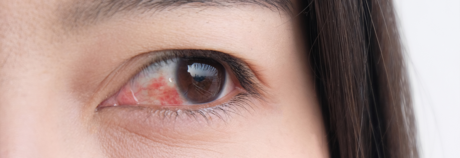 red-eyes-syndrome-causes-symptoms-and-treatment-of-conjunctivitis