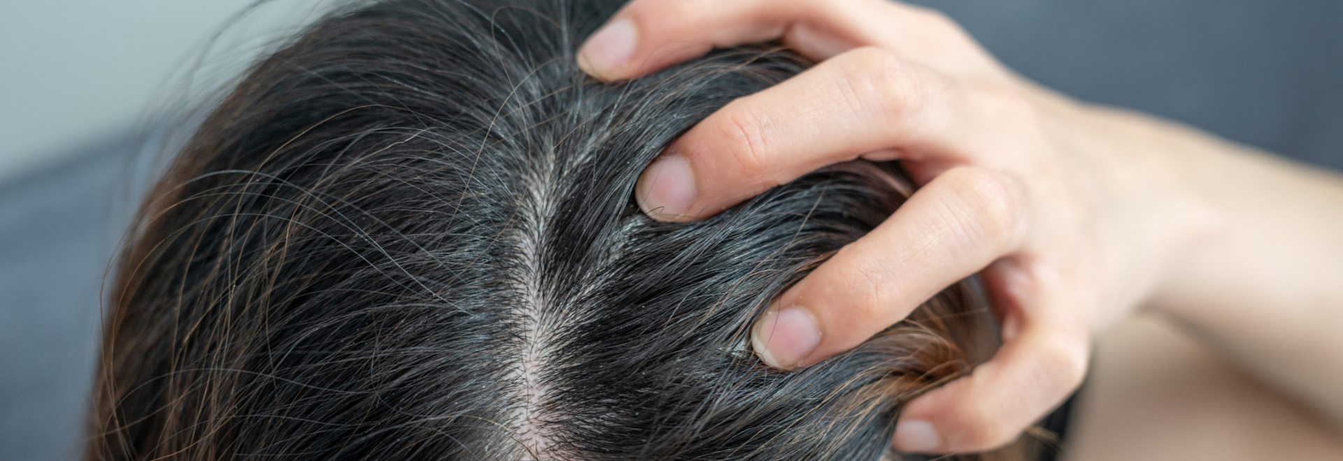 scalp-acne-causes-symptoms-treatment