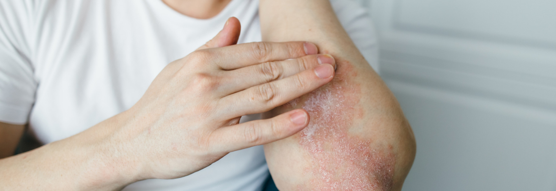 traditional-chinese-medicine-eczema-causes-symptoms-treatment