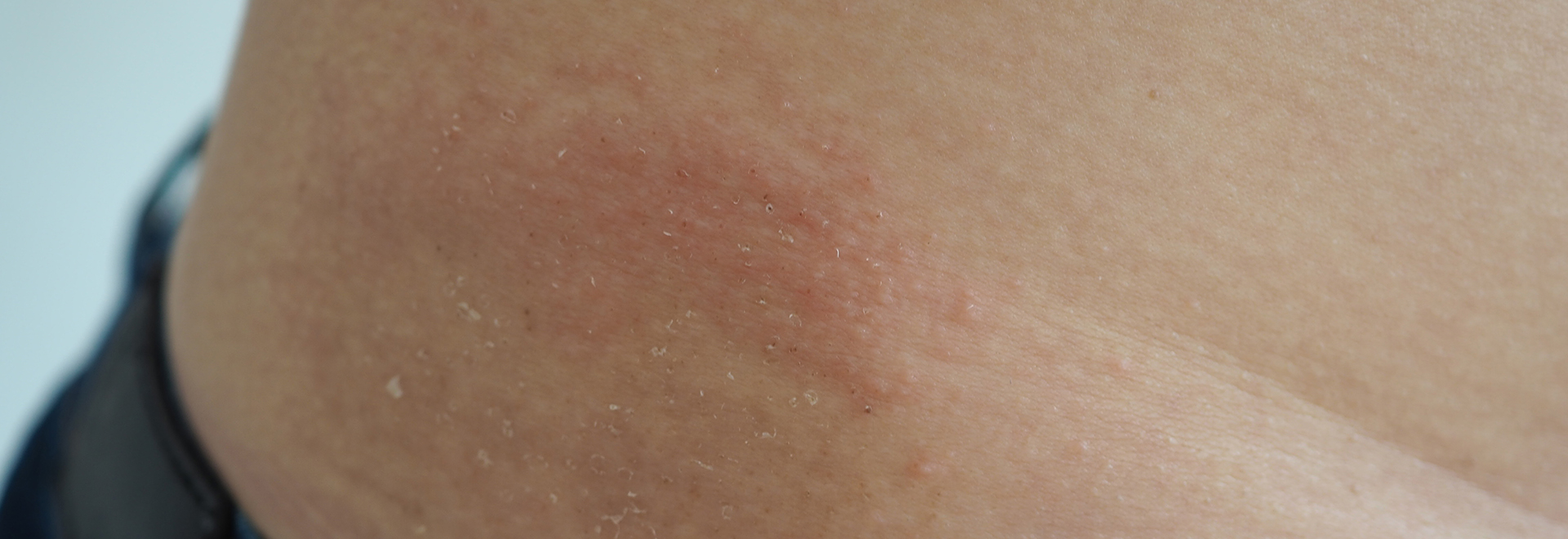 understanding-sweat-spots-rash-folliculitis